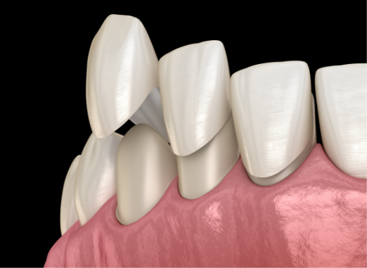 Same-Day Dental Crowns